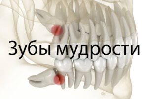 Зубы мудрости