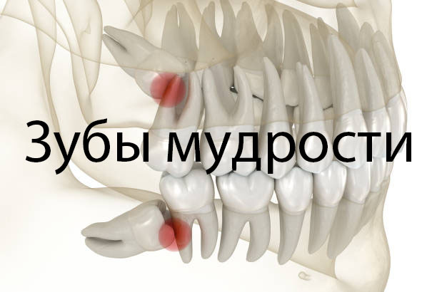 Зубы мудрости