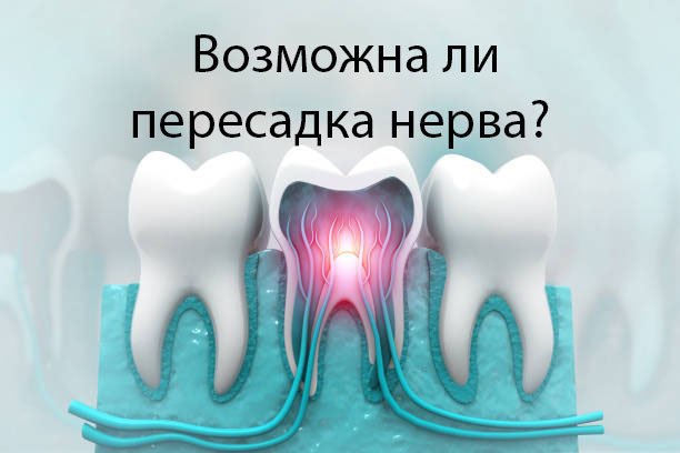 Возможно ли пересадка нерва из здорового зуба, в зуб в котором нет нерва?